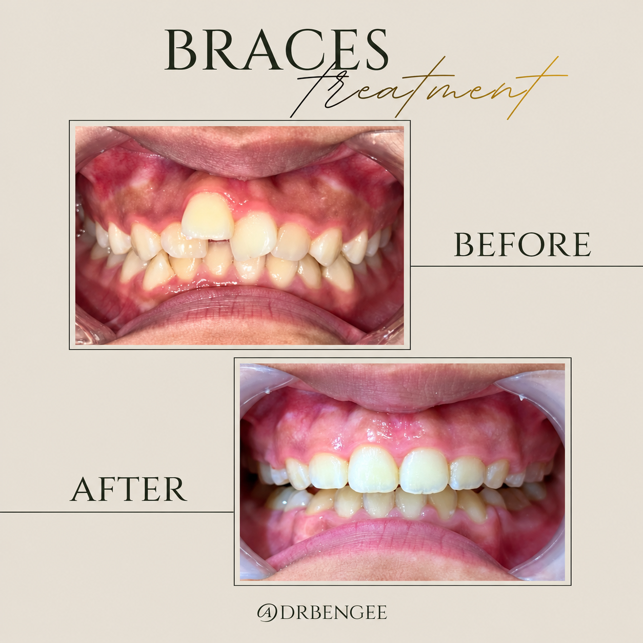 braces before after