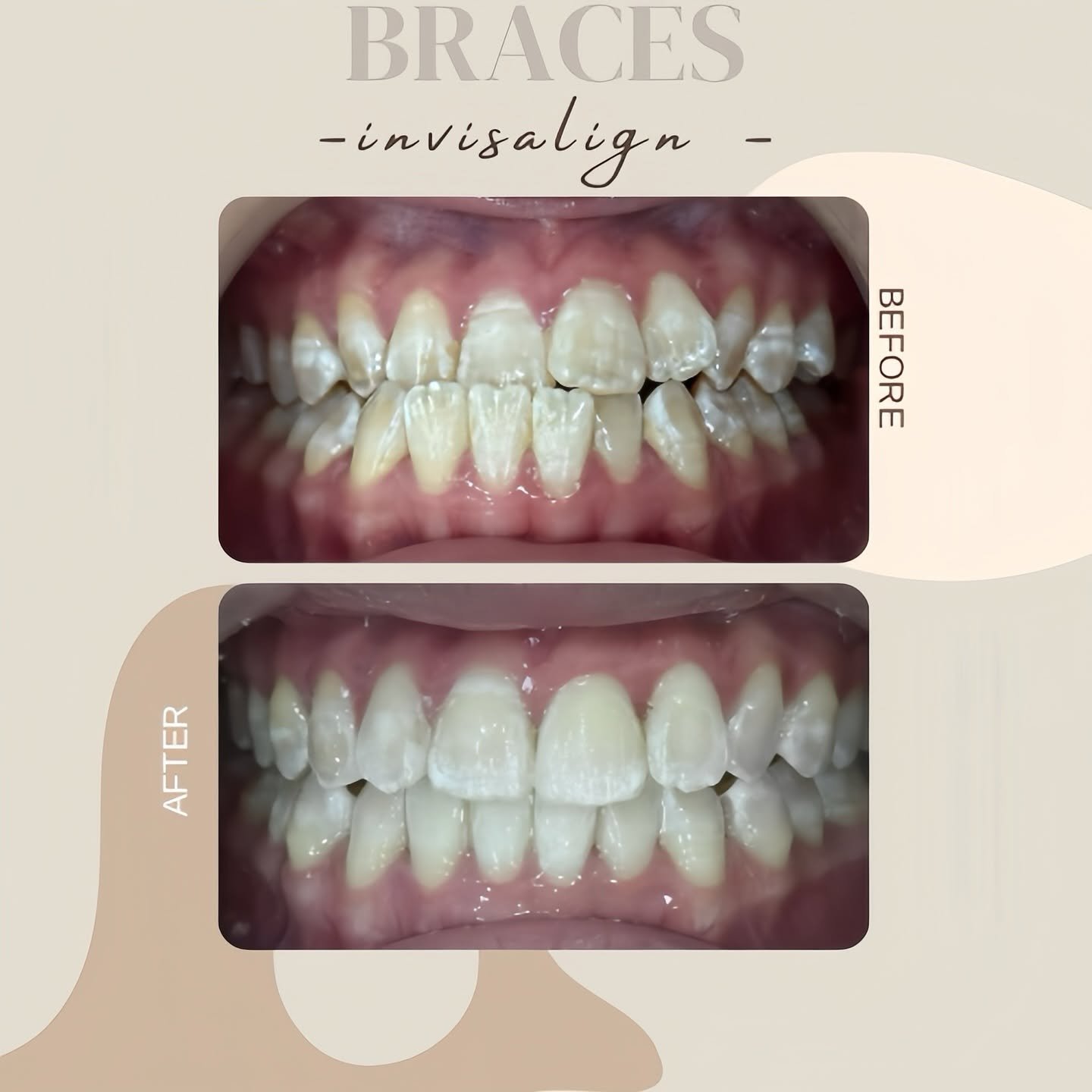 Delight Dental before and after smile comparison 1