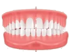 Crossbite dental illustration