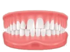 Crowding dental illustration