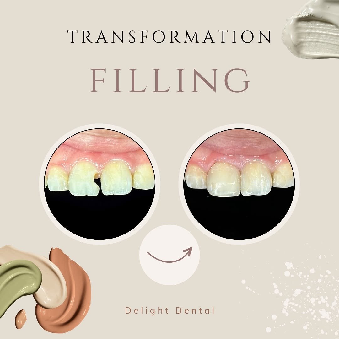 filling before after 2