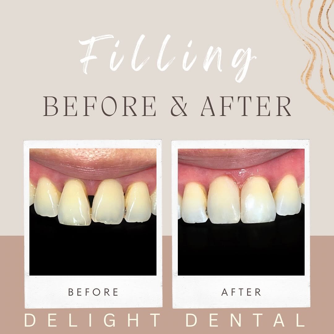 filling before after 4
