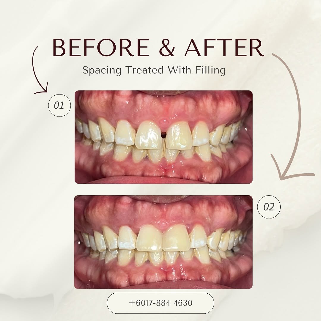 filling before after 5