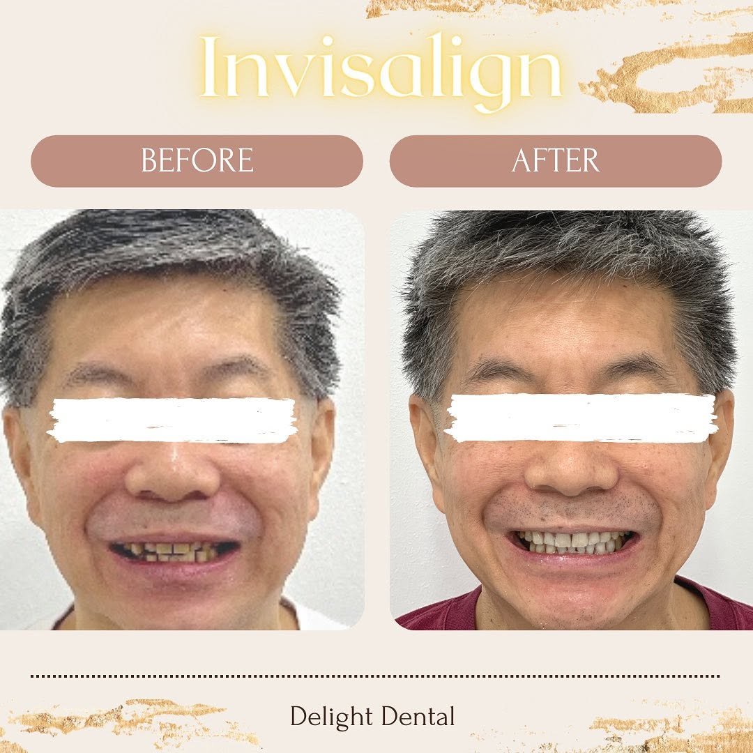 invisalign before after client image