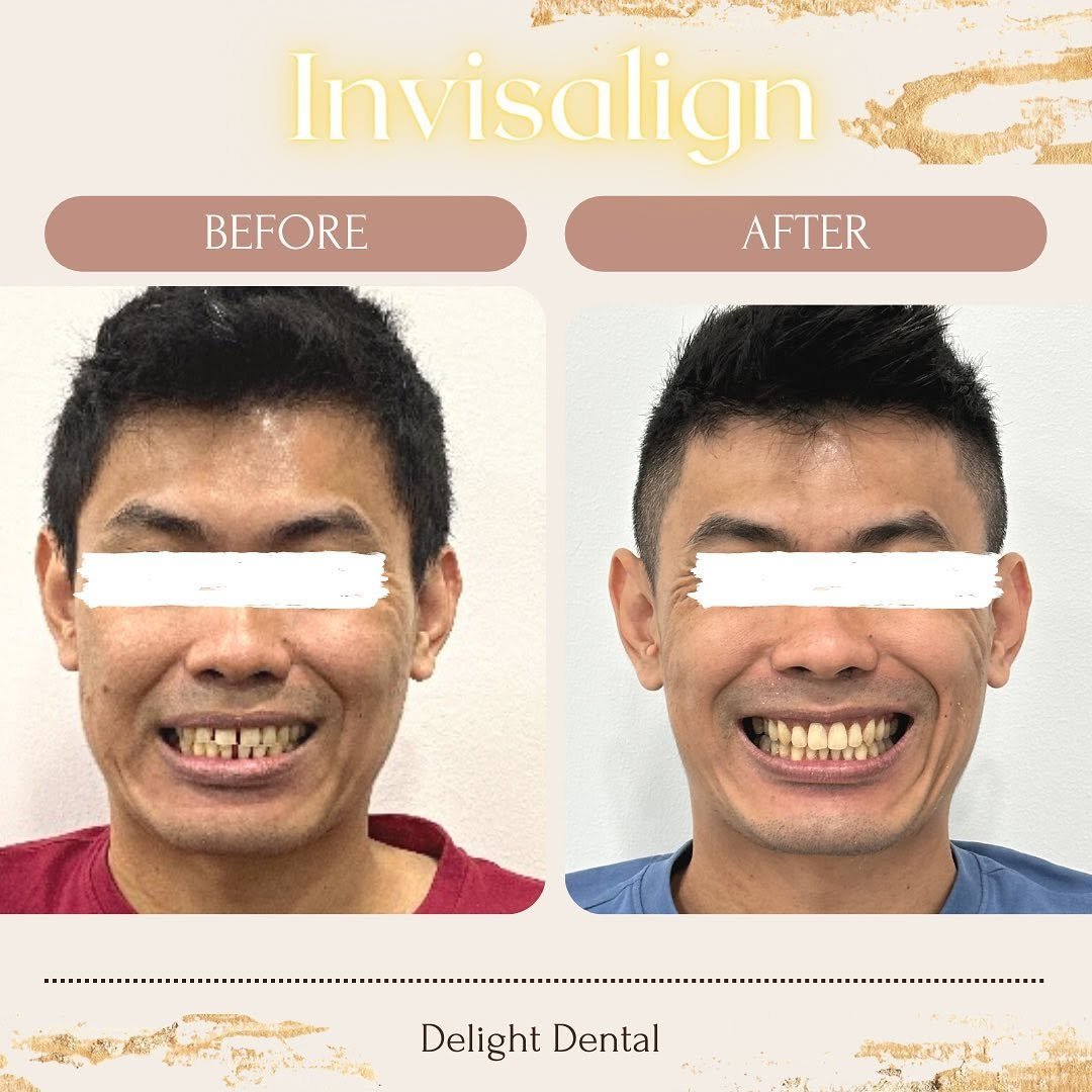 invisalign before after client image1
