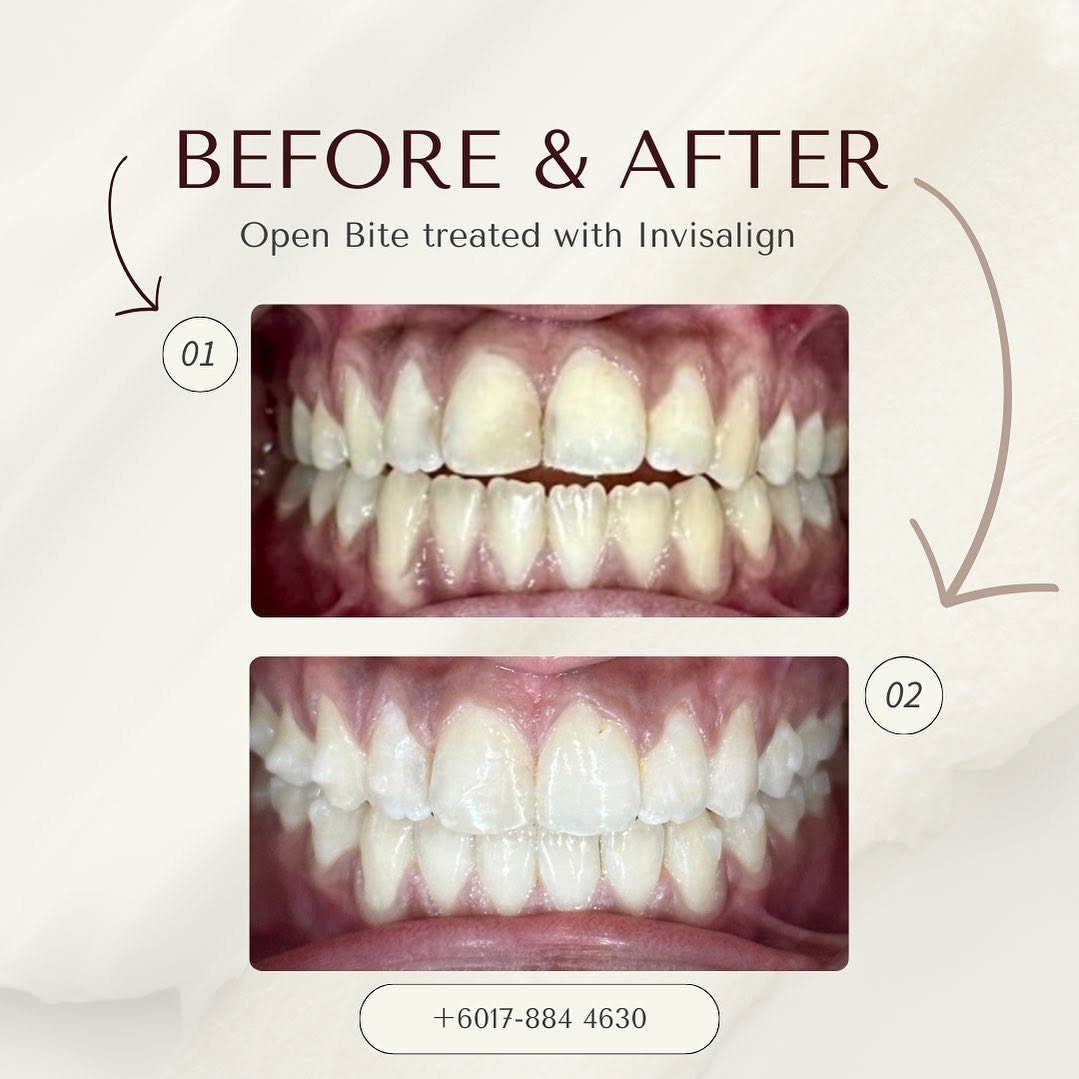 invisalign before after