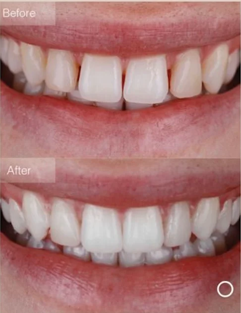 Invisalign Lite package illustration