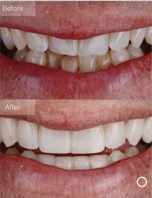 Invisalign Moderate package illustration