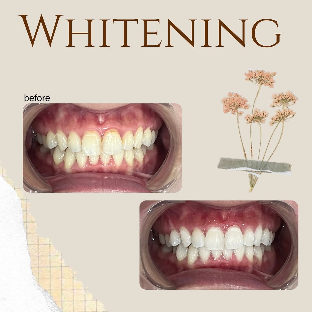 whitening before after 2