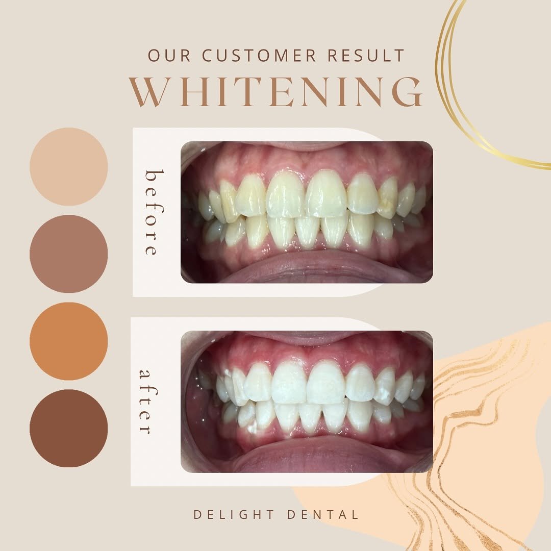 whitening before after